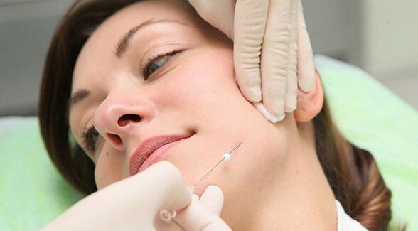 Thread lift a cosmetic face rejuvenation method after 45 years