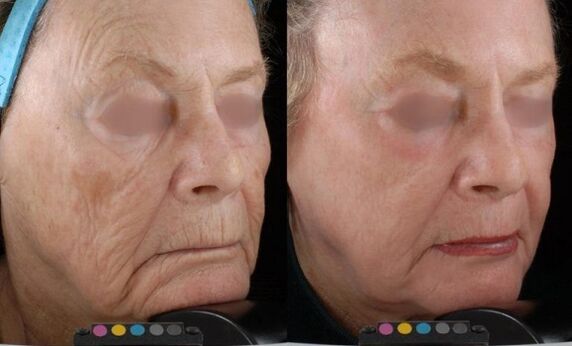photos before and after laser rejuvenation