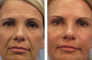 result of mesotherapy